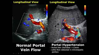 Liver Ultrasound Normal Vs Abnormal Image Appearances Comparison  Liver Pathologies USG [upl. by Ardnasak247]