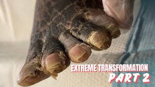 EXTREME FOOT TRANSFORMATION FINAL RESULT  PART 2 [upl. by Scharaga156]