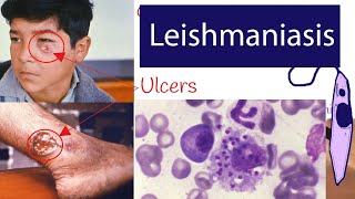 Leishmaniasis  Symptoms and Treatment of Leishmaniasis Explained under 3 minutes [upl. by Ecnal]