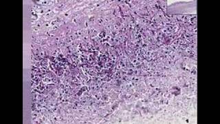 Histopathology Colon esophagus Candidiasis [upl. by Giuliana]