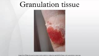 Granulation tissue [upl. by Schroeder273]