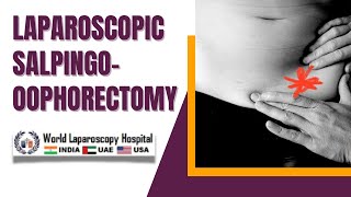 Laparoscopic Salpingooophorectomy for Recurrent Endometrioma A Comprehensive Video Overview [upl. by Midge]