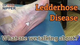 What is ledderhose disease How is ledderhose disease treated In the foot 2021 Callus Tuesday [upl. by Rehc]