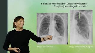 Hvordan ser Pneumothorax ut på røntgen Del 12 [upl. by Lehplar]