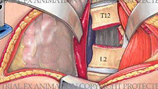 Lumbar Corpectomy and Fusion with Synthes Synex II Device [upl. by Vinita]