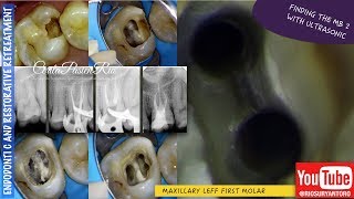 finding MB2 canal ultrasonic tip one curve micromega one visit endodontic treatment [upl. by Thadeus]