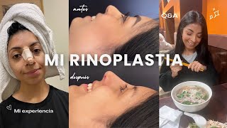 MI SEGUNDA RINOPLASTIA ULTRASÓNICA 🥲  experiencia postoperatorio antes y después 📸 [upl. by Rome]