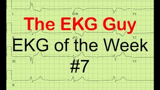 EKGECG of the Week 7  The EKG Guy  wwwekgmd [upl. by Nael190]