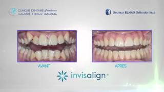 Cas Clinique  INVISALIGN [upl. by Sylado]