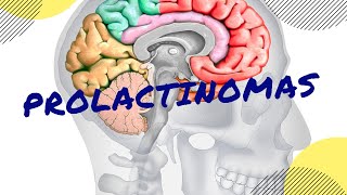 PROLACTINOMAS Causas síntomas diagnóstico y tratamiento [upl. by Irodim737]