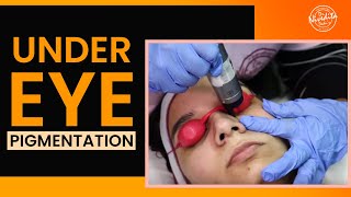 Laser treatment for dark circles under eyes  Under Eye Pigmentation Removal [upl. by Ernesto552]