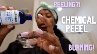 At Home Chemical Peel on Black Skin  Esthetician Approved [upl. by Block]