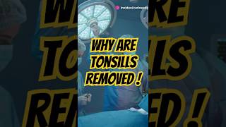 Tonsillectomy Explained in 60 Seconds 🧠 youtubeshorts facts [upl. by Ylellan]