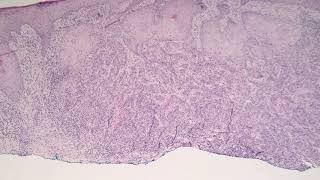 Squamous Cell Carcinoma Moderately Differentiated [upl. by Aled]