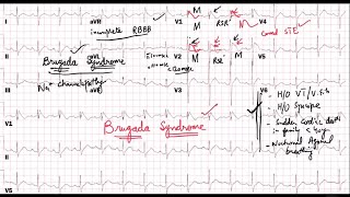 ECG quiz 3 explained Brugada Syndrome [upl. by Slavic]