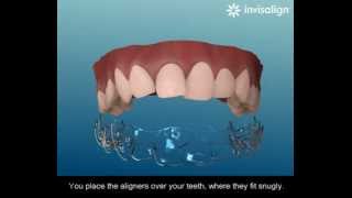 What is Invisalign [upl. by Ainahs961]