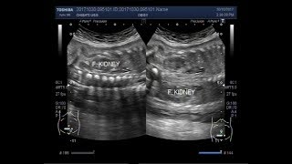 Ultrasound Video showing a fetus with distended urinary bladder and bilateral renal hydronephrosis [upl. by Dodi]