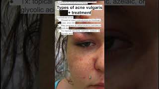 Types of acne vulgaris  treatment [upl. by Adnolaj]