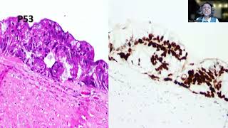 Tip82 Highgrade Appendiceal Mucinous Neoplasm [upl. by Ahsirek374]