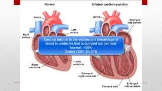 Cardiomyopathy CMP [upl. by Suirtemid340]