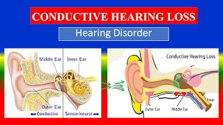 CONDUCTIVE HEARING LOSS  Definition types  cusses  Pathophysiology signs diagnoses treatment [upl. by Maltzman]