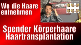 Körperhaare bei Haartransplantation Haarverpflanzung mit Körperhaare Medical Exclusive Erfahrung [upl. by Asiulairam732]