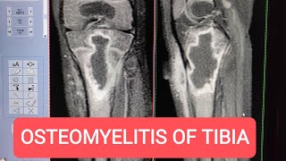 MRI of Tibia with Contrast  Diagnosing Osteomyelitis on GE 15 Tesla [upl. by Ekle1]