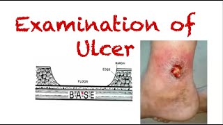 Examination of Ulcer  A guide for surgical case evaluation [upl. by Yrahca]