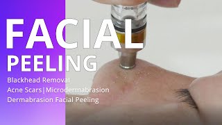 Blackhead Removal  Acne Scars  Microdermabrasion Dermabrasion Facial Peeling [upl. by Anelam]