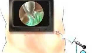 PreOp® Patient Education Laparoscopy Diagnostic Surgery [upl. by Ailhat]