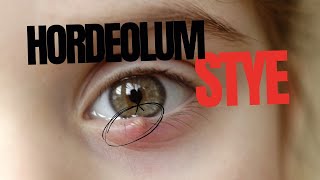 Stye Hordeolum [upl. by Slosberg]