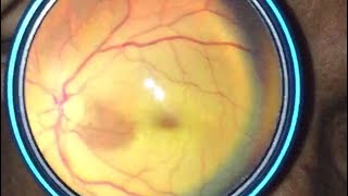 Cherry Red Spot  Central Retinal Artery Occlusion CRAO Indirect Ophthalmoscopy using Smartphone [upl. by Meeharbi]