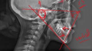 12 Tweed triangle Cephalometric analysis [upl. by Ytok928]