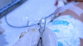 NICU में बेबी को enema कैसे लगाए enema videos nicu viral newborn Nursingwithchandan [upl. by Talbot]