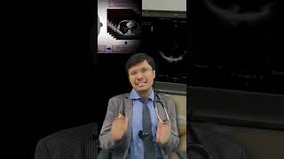 Echo Comparison Heart Attack vs Pulmonary Embolism इको अंतर हार्ट अटैक vs पल्मोनरी [upl. by Damiani]