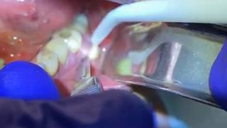 Draining a Dental Abscess  Advanced Dental Care [upl. by Merton]