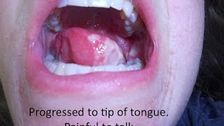 Tongue Cancer Radiation Treatment See what happened to me [upl. by Courcy]