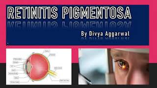 RETINITIS PIGMENTOSA RP IntroductionSymptoms amp Diagnosed Full Explained in Hindi [upl. by Adirehs]