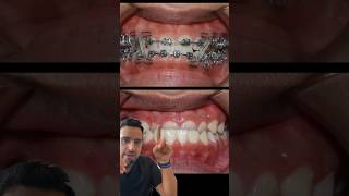 Cas ORTHODONTIE  l’INVERSÉ d’occlusion DENTAIRE [upl. by Wehttan]