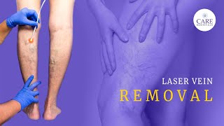 Laser Vein Removal  Treatment for Varicose Veins  CARE Hospitals [upl. by Dunn920]