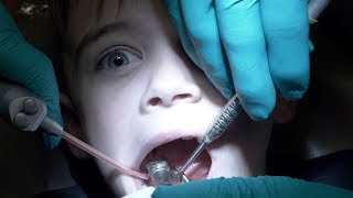 DENTAL HEALTH VLOG  HIS FIRST CAVITY FILLING  TWO CAVITIES [upl. by Fortunia]