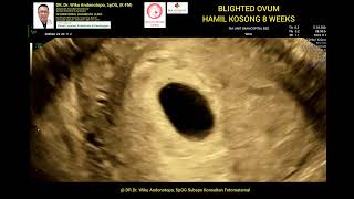 Blighted Ovum 8 weeks [upl. by Auqeenahs]