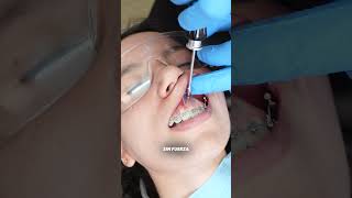 INSTALACIÓN DE MICROTORNILLOS con BRACKETS [upl. by Karney]