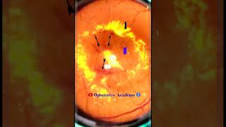 Diabetic Retinopathy  CSME  Retina  Short Video 171 akleshkumar optometrist [upl. by Enomsed773]