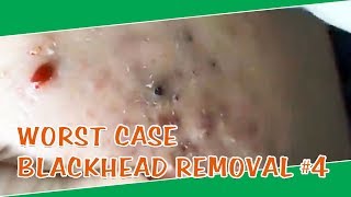 How to Get Rid of Blackheads amp Whiteheads on The Face  Worst Case Removal Blackheads 4 [upl. by Sardse]