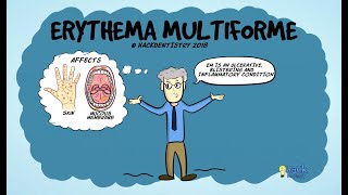 Erythema multiforme [upl. by Harmaning724]