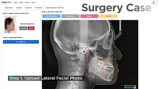 New Feature of WebCephCephalometric Analysis Platform Treatment Simulation [upl. by Agustin]