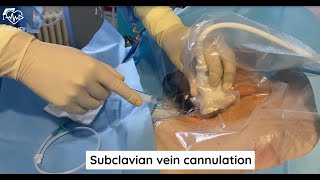 SUBCLAVIAN CENTRAL LINE PLACEMENT WATCH LIVE VIDEO [upl. by Zitella140]