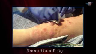 WCW Abscess Incision and Drainage [upl. by Lacee]