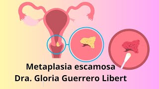 Metaplasia Escamosa en mi papanicolaou ¿Que hacer [upl. by Krall732]